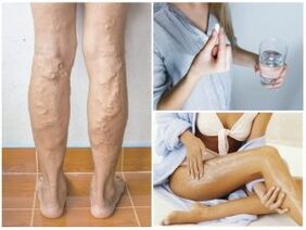Varices nas pernas e métodos de tratamento